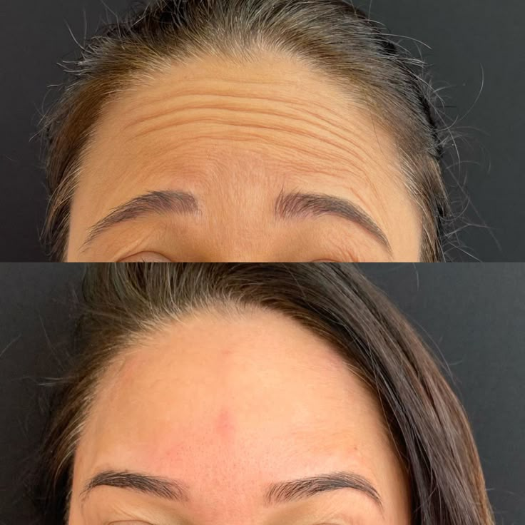 Botox Day — 3 Áreas